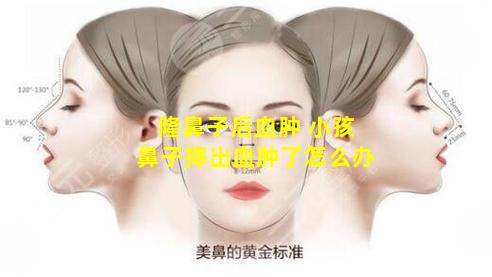 隆鼻子后血肿 小孩鼻子摔出血肿了怎么办